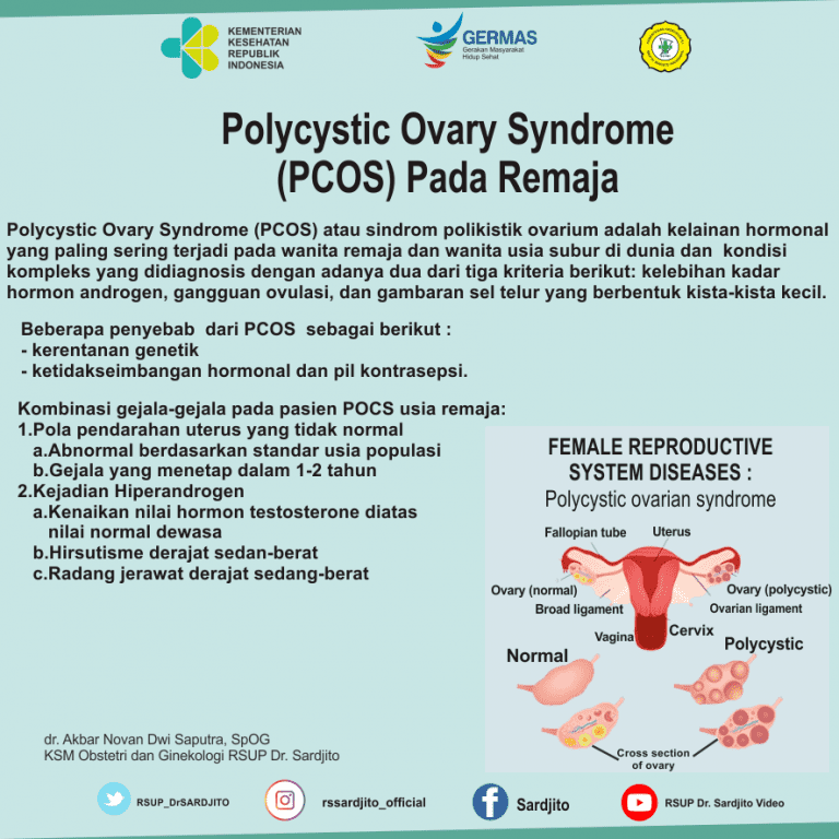 Rsup Dr Sardjito Polycystic Ovary Syndrome Pcos Pada Remaja